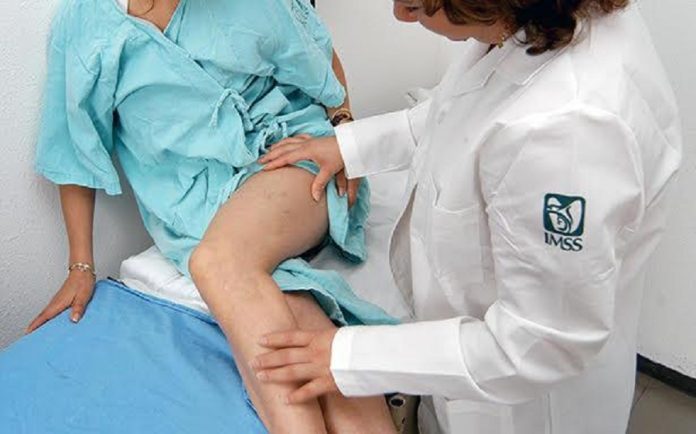 Recomienda IMSS Tlaxcala Evitar Sedentarismo y Cuidar peso Corporal, para Prevenir Insuficiencia Venosa Crónica “Várices” -AlternativaTlx
