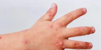 Gobierno Municipal de Zacatelco Anuncia Medidas Preventivas Contra el Virus Coxsackie en Niñas y Niños. - AlternativaTlx